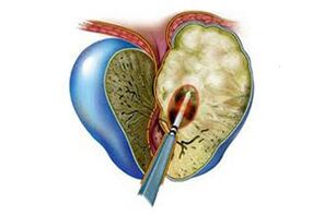 Симптомы острого простатита